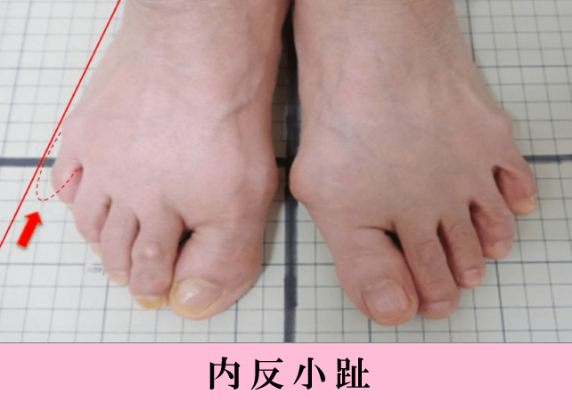 フットカウンセリング 岩国市の病院 大谷整形外科